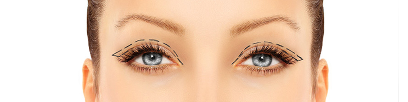 blepharoplastie tunisie