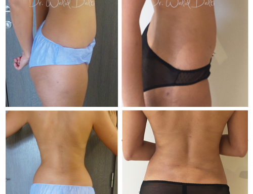 Liposuccion et lipofilling des seins