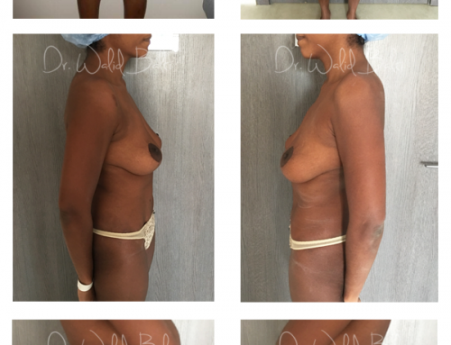 Lipoaspiration, plastie abdominale cure diastasis musculaire & plastie mammaire de réduction avec lifting des seins