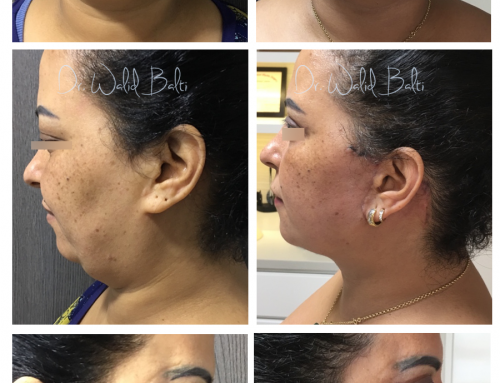 Liposuccion cou, lift cou et blépharoplastie supérieure