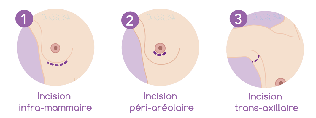 incisons augmentation mammaire tunisie