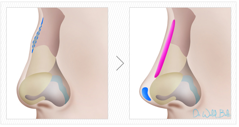 rhinoplastie augmentation tunisie