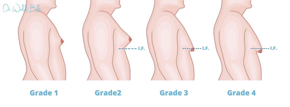 la gynecomastie tunisie