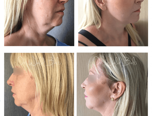 Lifting cervico-facial et lipofilling du visage