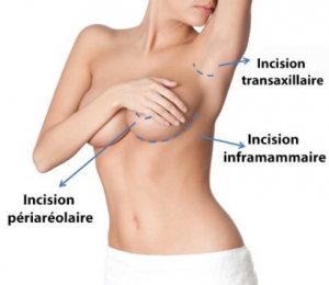 incisions augmentation mammaire tunisie