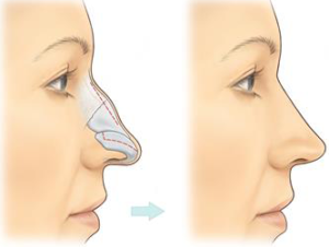 correction bosse nasale tunisie