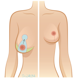 reduction seins tunisie