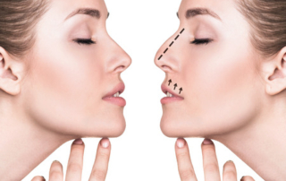 rhinoplastie tunisie