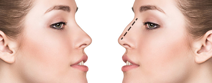 rhinoplastie medicale tunisie