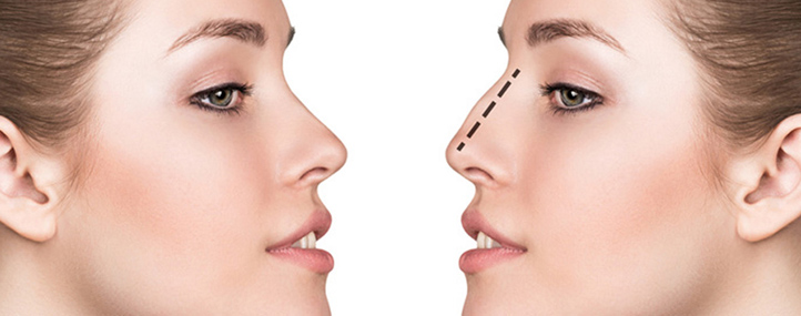 rhinoplastie medicale tunisie