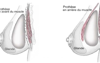 position implants mammaires tunisie