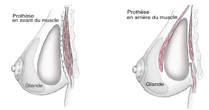 position implants mammaires tunisie