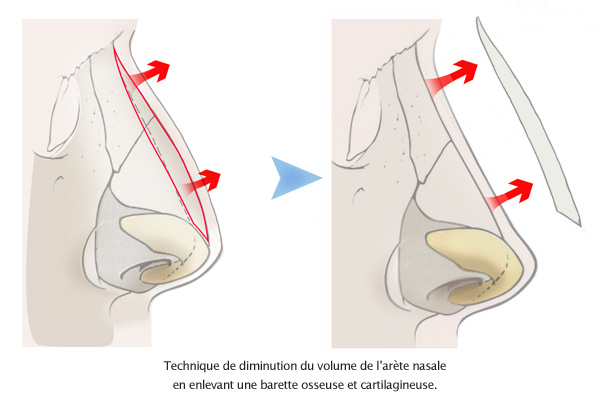 rhinoplastie esthetique arete nasale tunisie