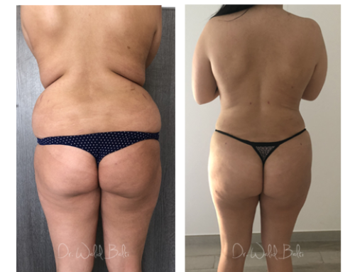 Liposuccion et lipofilling des fesses