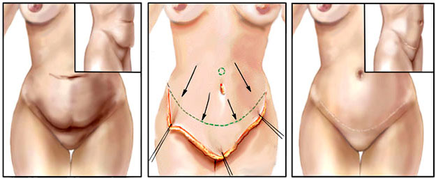 cicatrices abdominoplastie