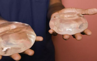 implants mammaires