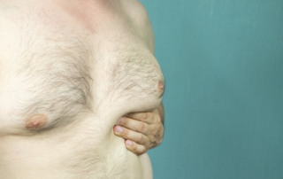 gynecomastie tunisie