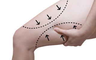 lipo cuisses