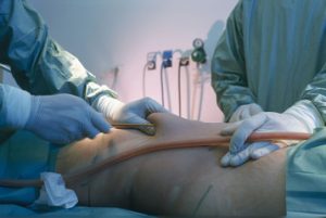 la liposuccion