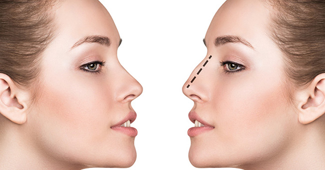 rhinoplastie reduction tunisie