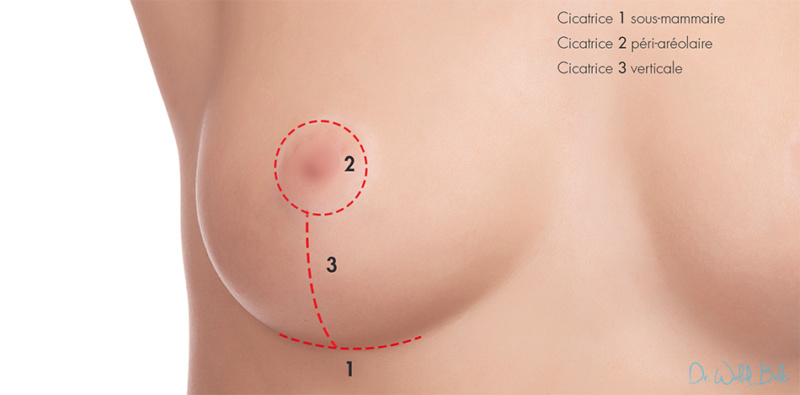 cicatrices lifting seins