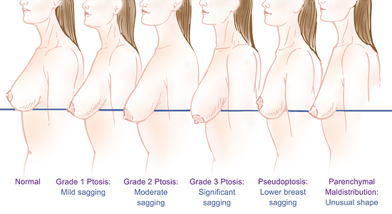 classification ptose mammaire