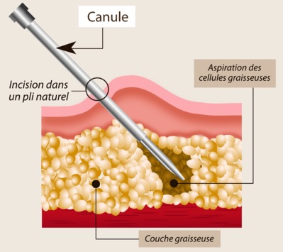 liposculpture tunisie