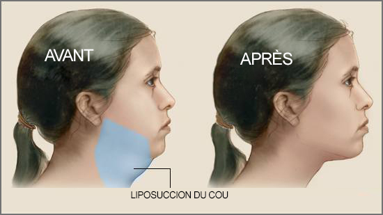 cou liposuccion