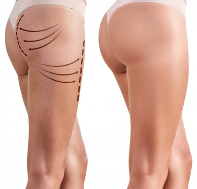 implants fessiers tunis