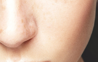 rhinoplastie-pointe-du-nez-tunisie