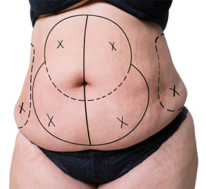 abdominoplastie premiere consultation