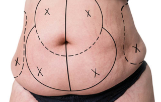 abdominoplastie premiere consultation