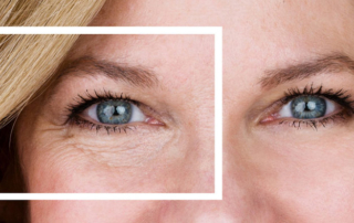 chirurgie esthetique posche sous yeux