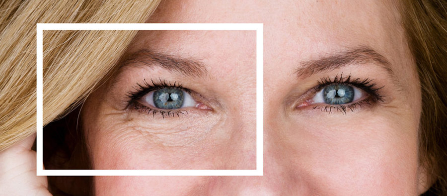 chirurgie esthetique posche sous yeux