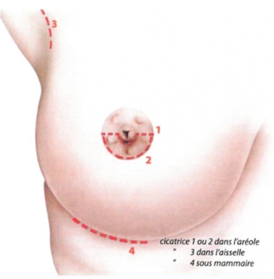 Incision augmentation mammaire