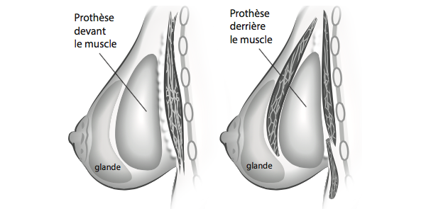 implant derriere devant le muscle