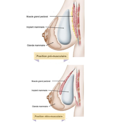 position augmentation mammaire