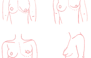 malformations seins