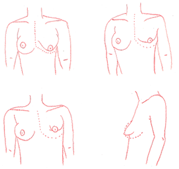 malformations seins