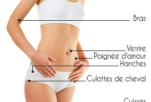 zones liposuccion
