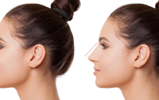 rhinoplastie en tunisie
