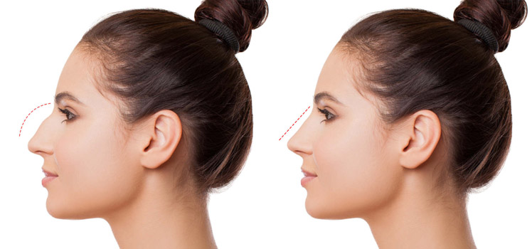 rhinoplastie en tunisie