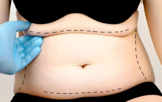 abdominoplastie