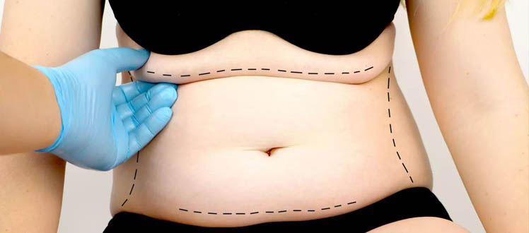 abdominoplastie