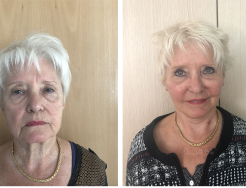 Lifting cervico-facial et lipofilling du visage