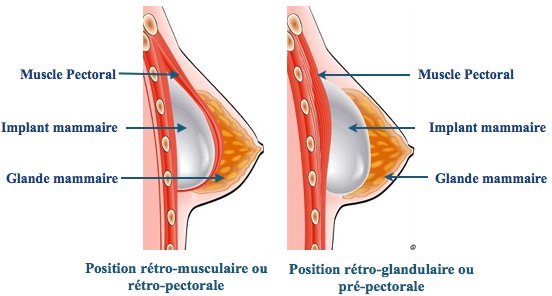 les differentes positions des protheses