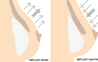 implant anatomique rond chirurgie esthetique