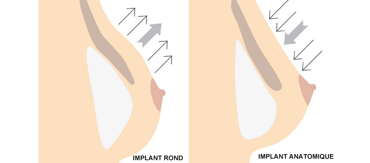 implant anatomique rond chirurgie esthetique