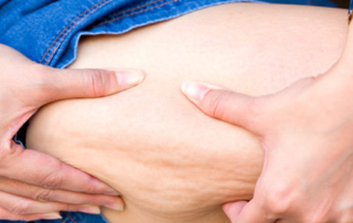 liposuccion peut elle éliminer la cellulite