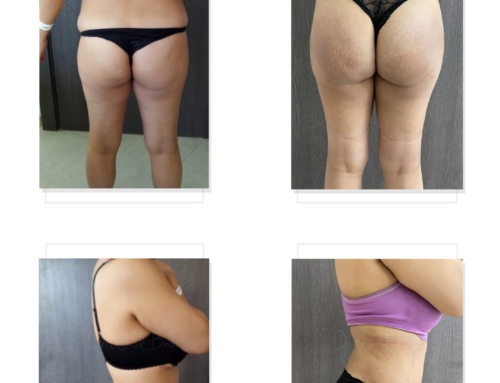 Liposuccion 360 et lipofiling des fesses